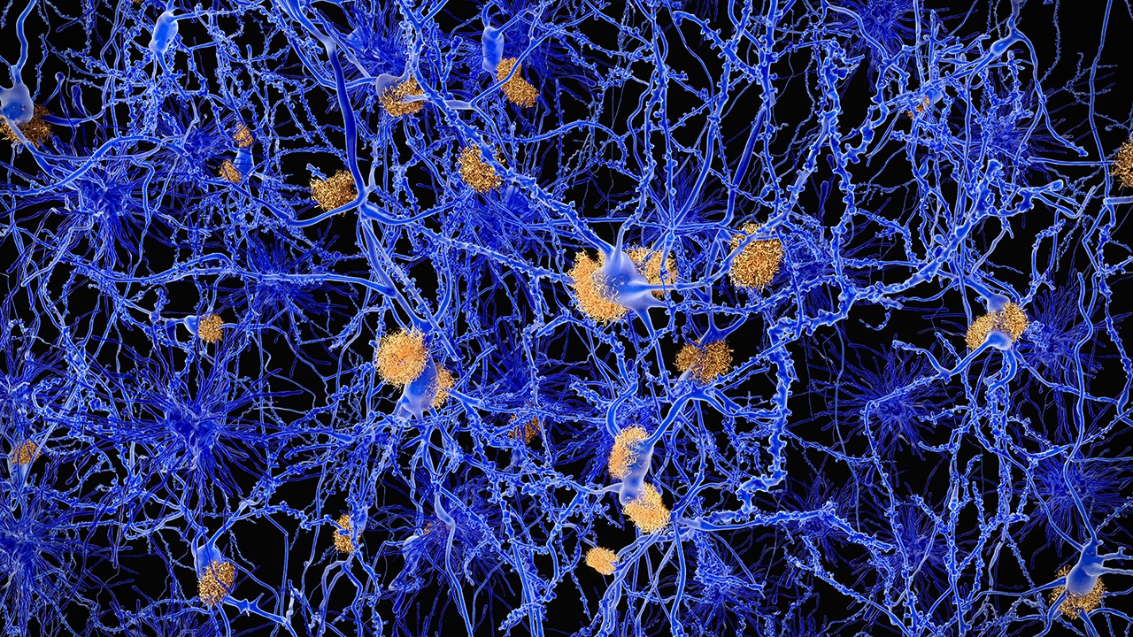 microscope image of neurons affected by alzheimer disease